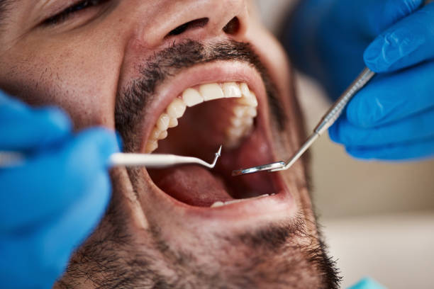 Best Emergency Root Canal Treatment in Mitchell, IL